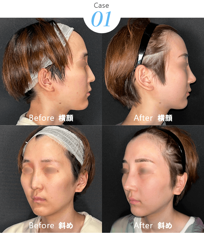 Case01 Before After