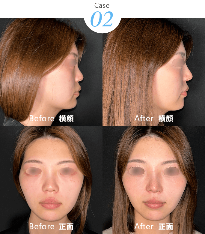 Case02 Before After
