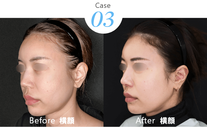 Case02 Before After