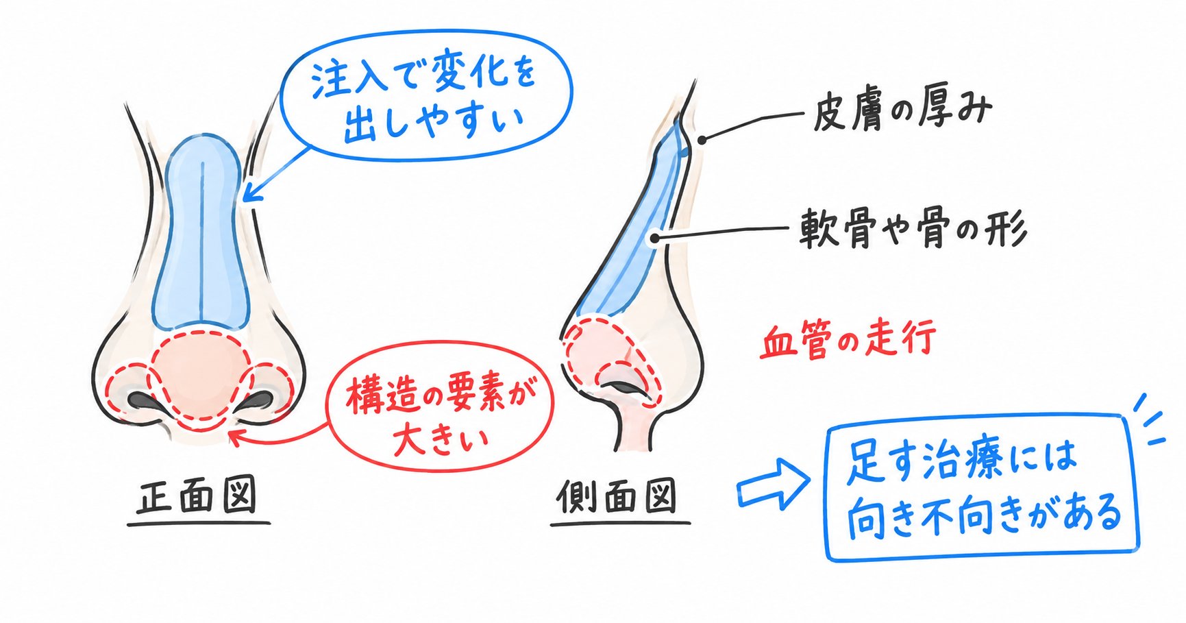 鼻先の丸みや小鼻の広がりはヒアルロン酸で変えられる部位なのか