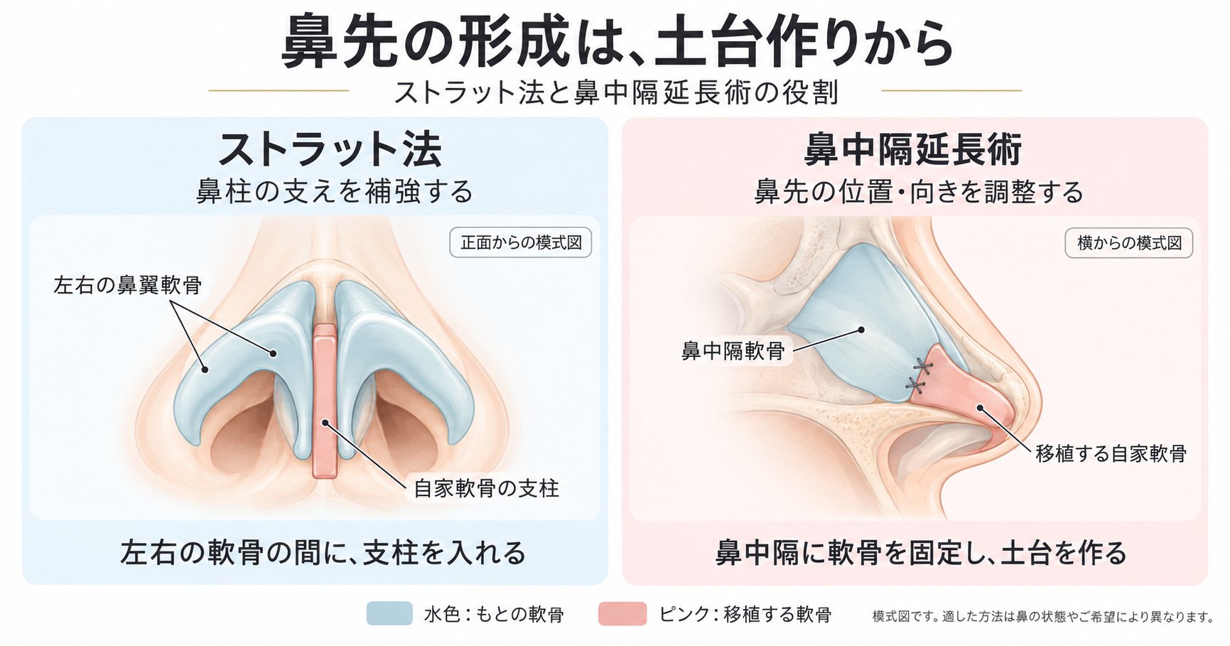 鼻先の形成は土台作りから｜鼻中隔延長術・ストラット法と自家軟骨の選び方