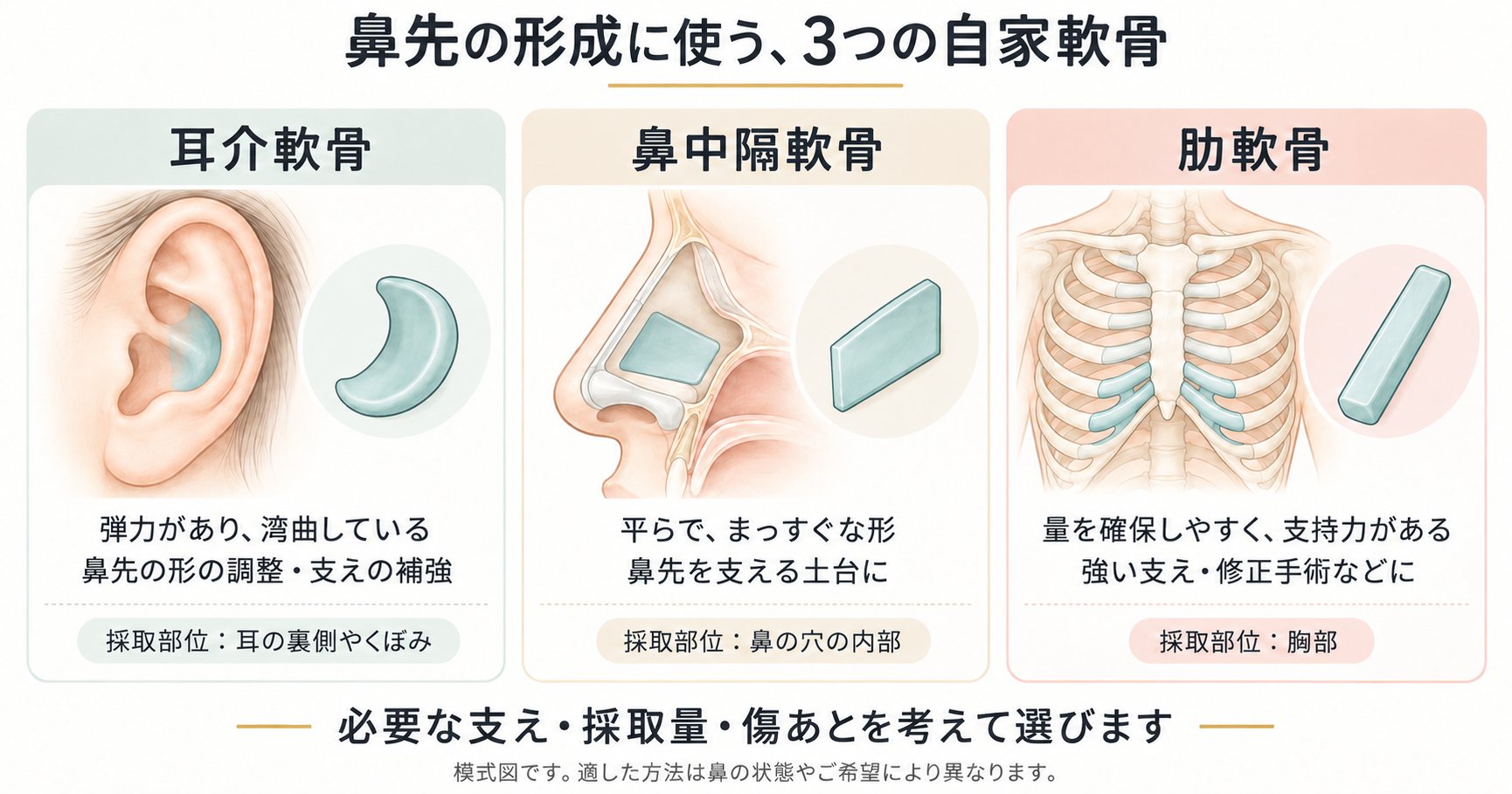 耳介軟骨・鼻中隔軟骨・肋軟骨の特徴と採取部位の傷あと