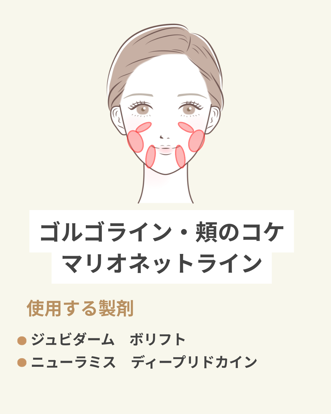 頬のコケ・マリオネットライン