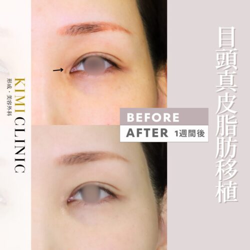 修正手術で叶える理想の目元へ～目頭切開修正真皮脂肪移植術～