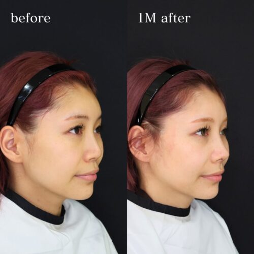 症例解説：中顔面から立体的に仕上げる鼻整形