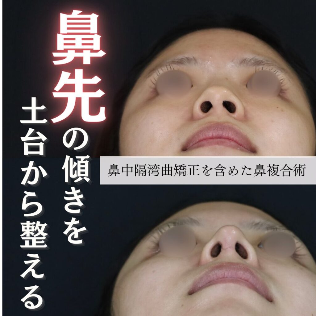 症例解説：鼻先の曲がり・丸み・低さを整える複合手術 - 大阪（東大阪