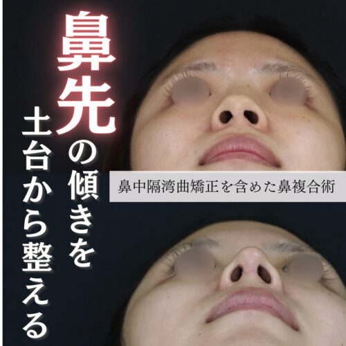 症例解説：鼻先の曲がり・丸み・低さを整える複合手術