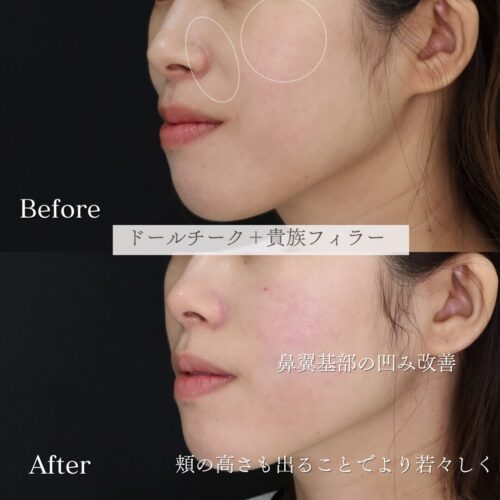 鼻翼基部　ヒアルロン酸　症例