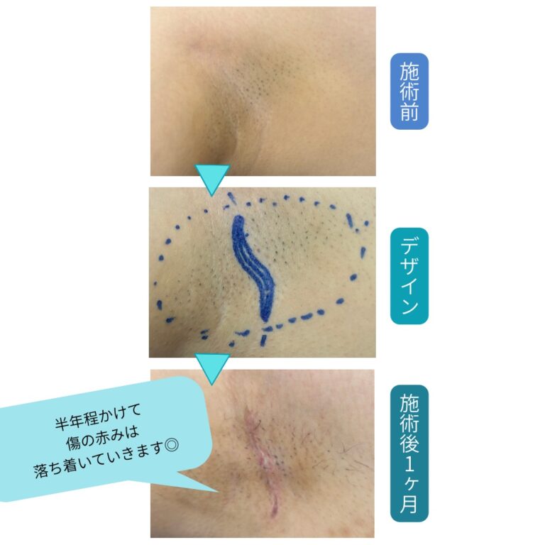 【症例解説】腋臭症（わきが）手術について ～傷を目立たせず、根本治療を目指す外科治療～ - 大阪・東大阪の美容外科・形成外科 KIMI ...