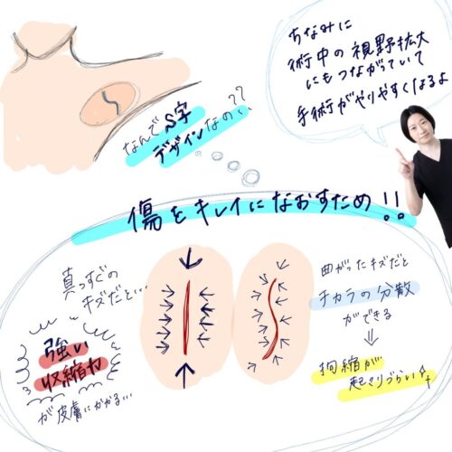 【症例解説】腋臭症（わきが）手術について　～傷を目立たせず、根本治療を目指す外科治療～