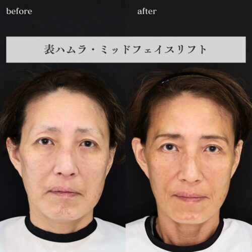 【症例解説】表ハムラ＋ミッドフェイスリフト～クマだけじゃない！中顔面のたるみを同時に改善～