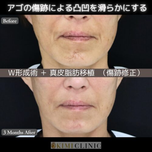 【症例解説】形成外科専門医によるW形成＋真皮脂肪移植で“傷を目立たなくする”