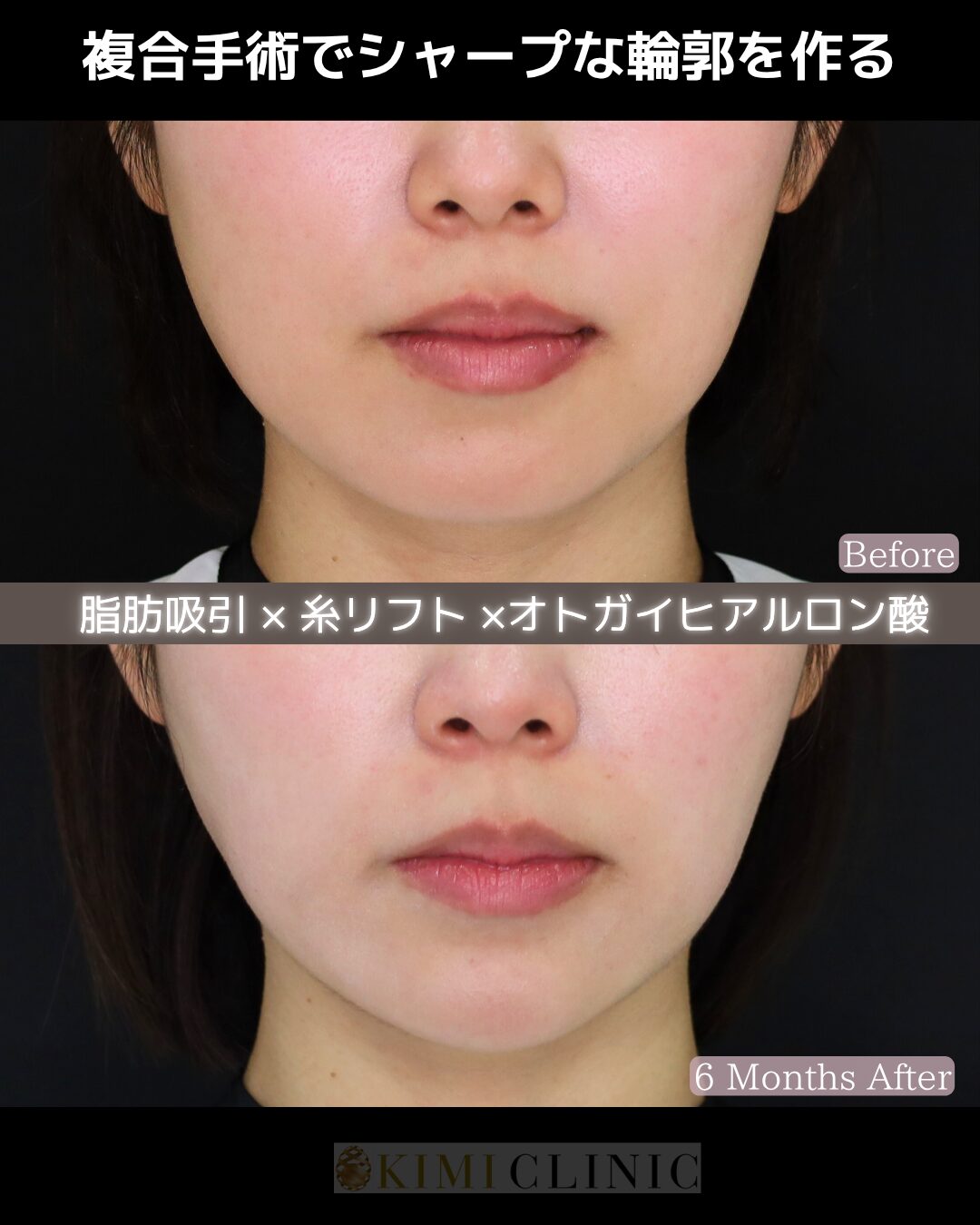 「サクションリフト（脂肪吸引×糸リフト）＆ 顎ヒアルロン酸」の術前・術後比較Before写真