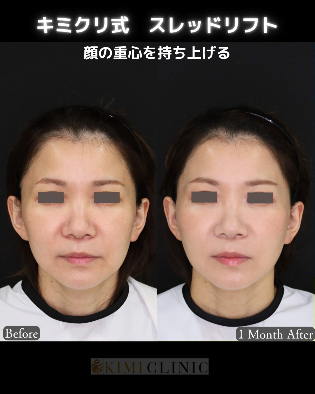 「スレッドリフト」の術前・術後比較Before写真