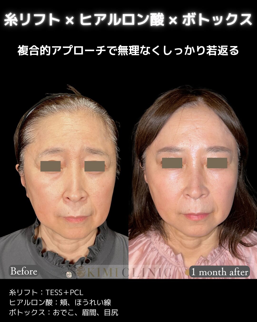 「ヒアルロン酸 × 糸リフト、ボトックス」の術前・術後比較Before写真