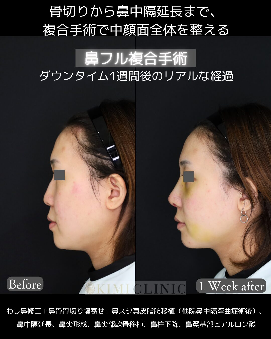 「鼻フル複合手術」１週間後ダウンタイム経過Before写真