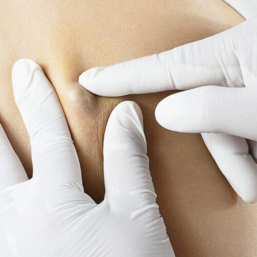 粉瘤とは？できやすい人の特徴はある？治療法・予防法なども解説