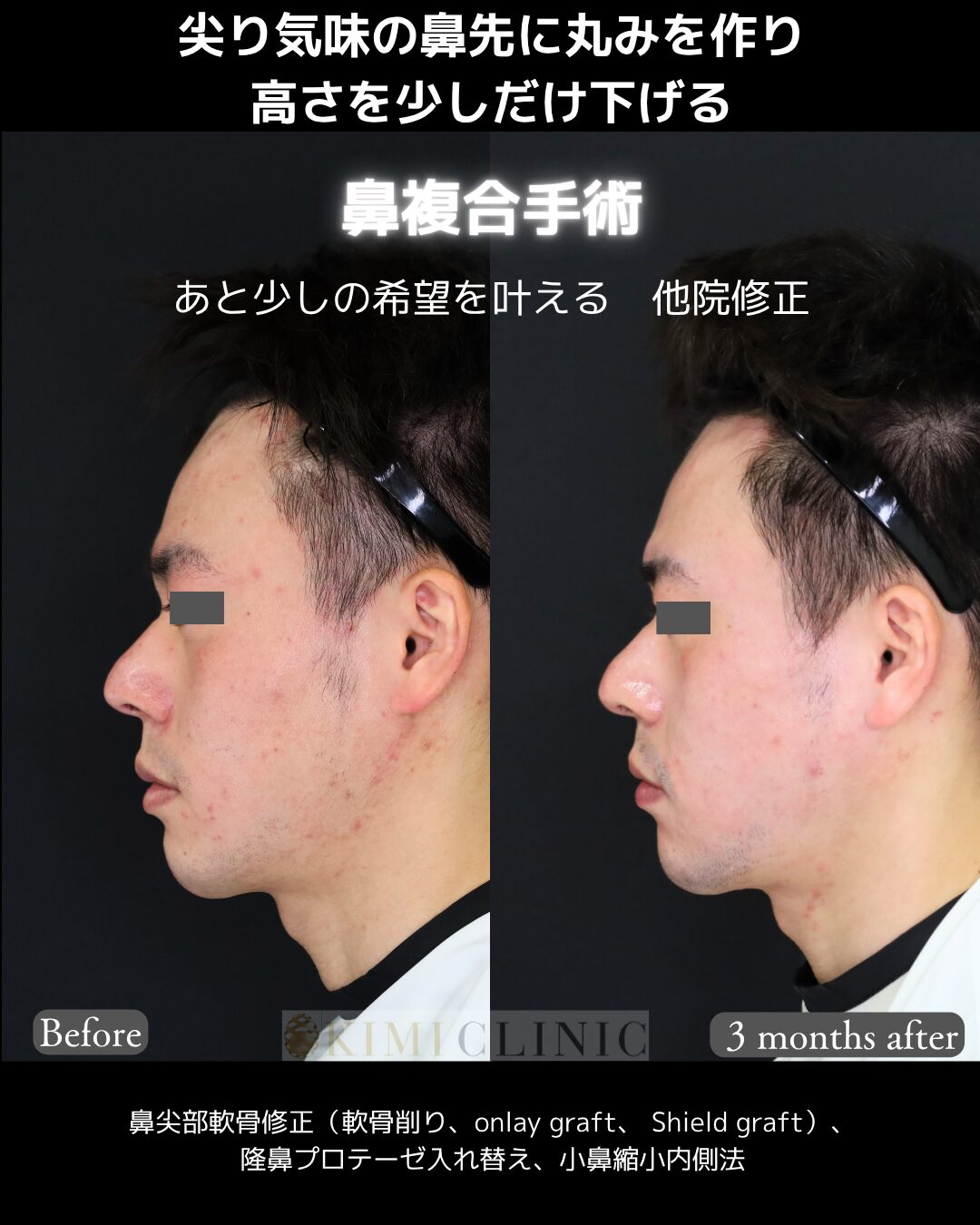 「Men’s 鼻整形（他院修正）」の術前・術後比較Before写真