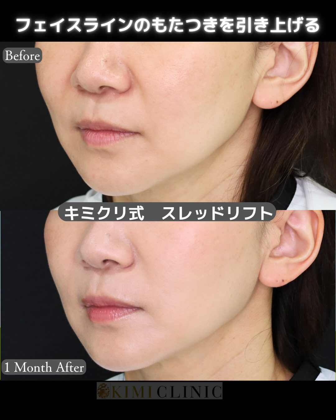 「スレッドリフト」の術前・術後比較Before写真