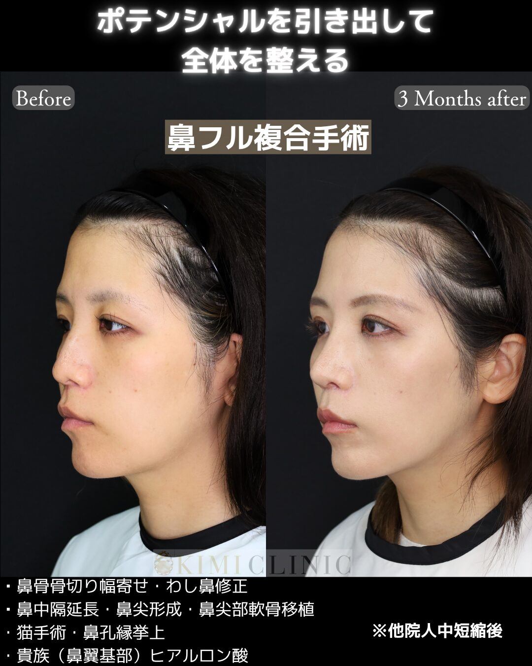 「鼻フル複合手術」の術前・術後比較Before写真