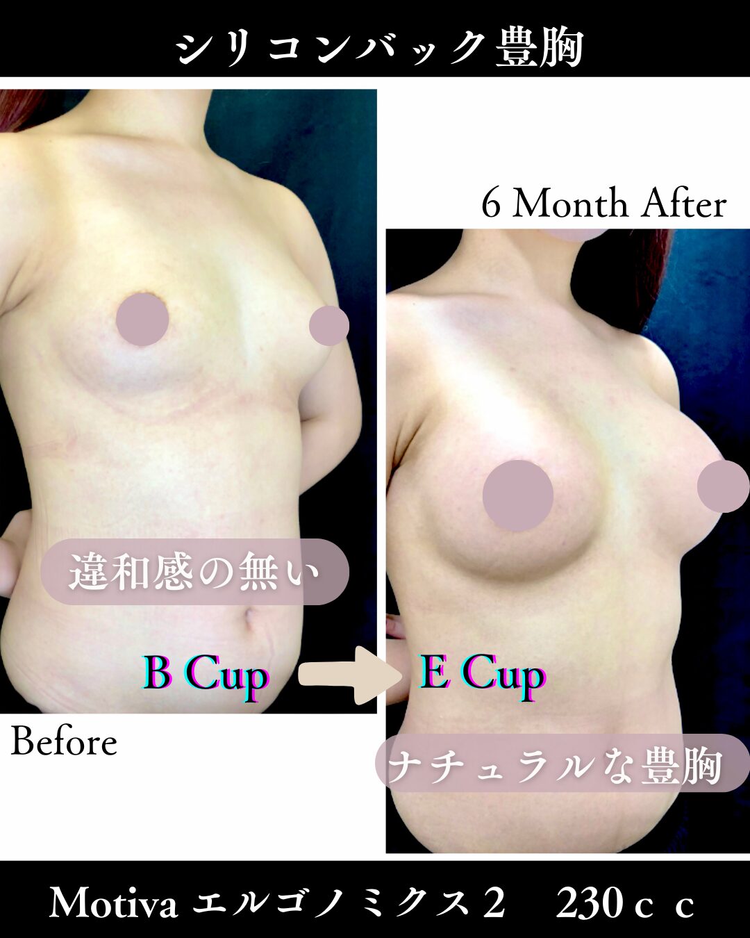 「シリコンバック豊胸」の術前・術後比較Before写真