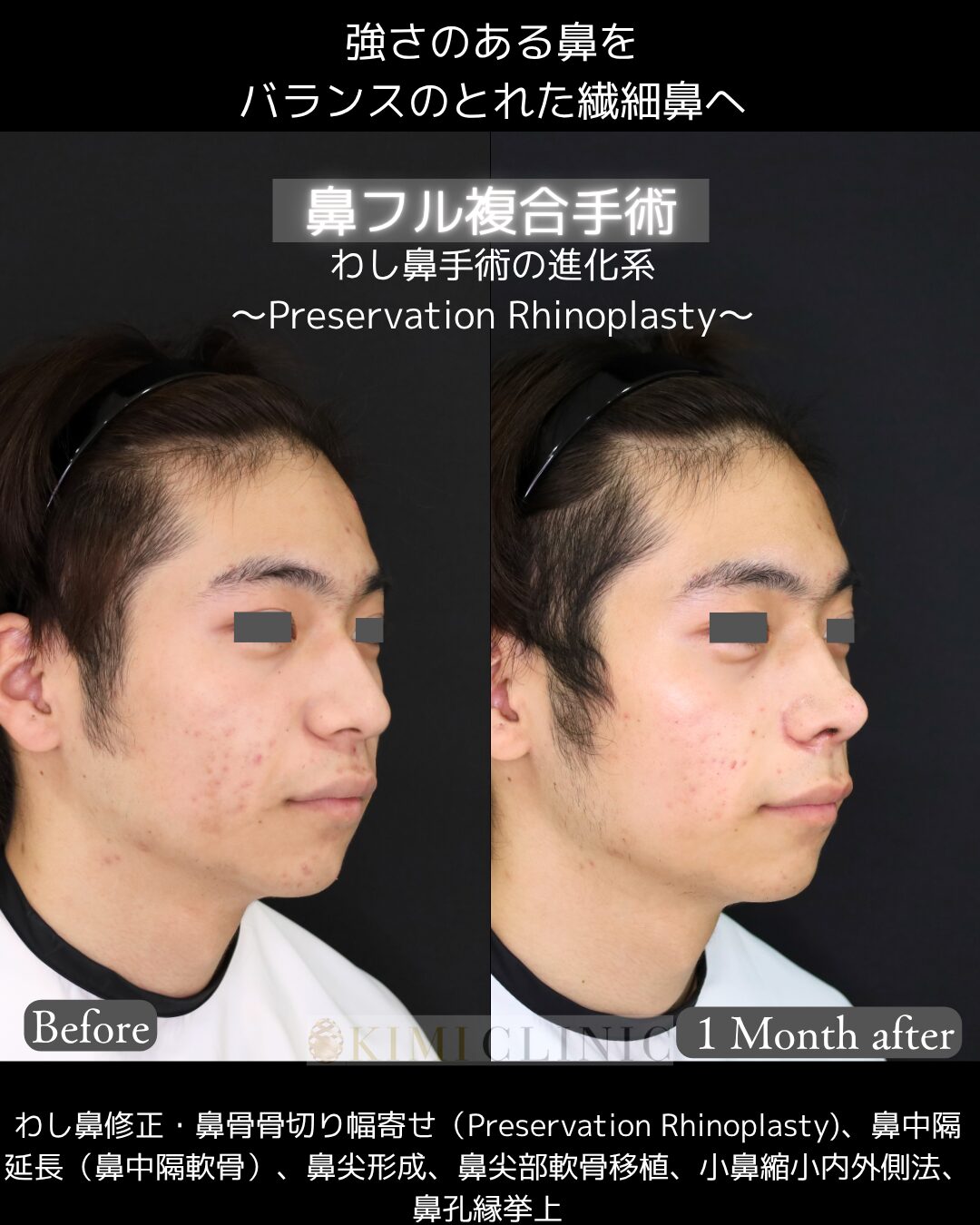 「鼻フル複合手術」の術前・術後１か月比較Before写真