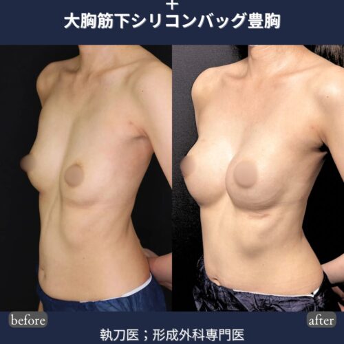 アクアフィリング豊胸後のしこり・変形・痛みでお悩みの方へ｜除去と同時に整える大胸筋下シリコンバッグ豊胸