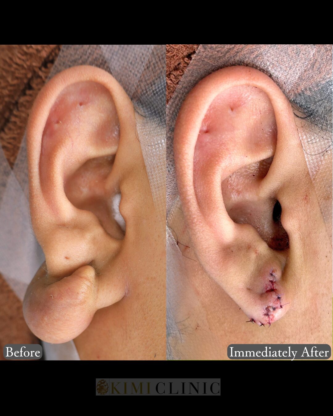 「耳垂ケロイド切除」の術前・術直後比較Before写真