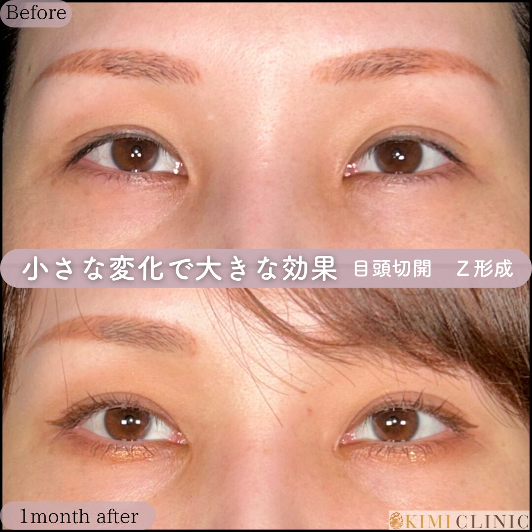 「目頭切開」の術前・術後比較Before写真