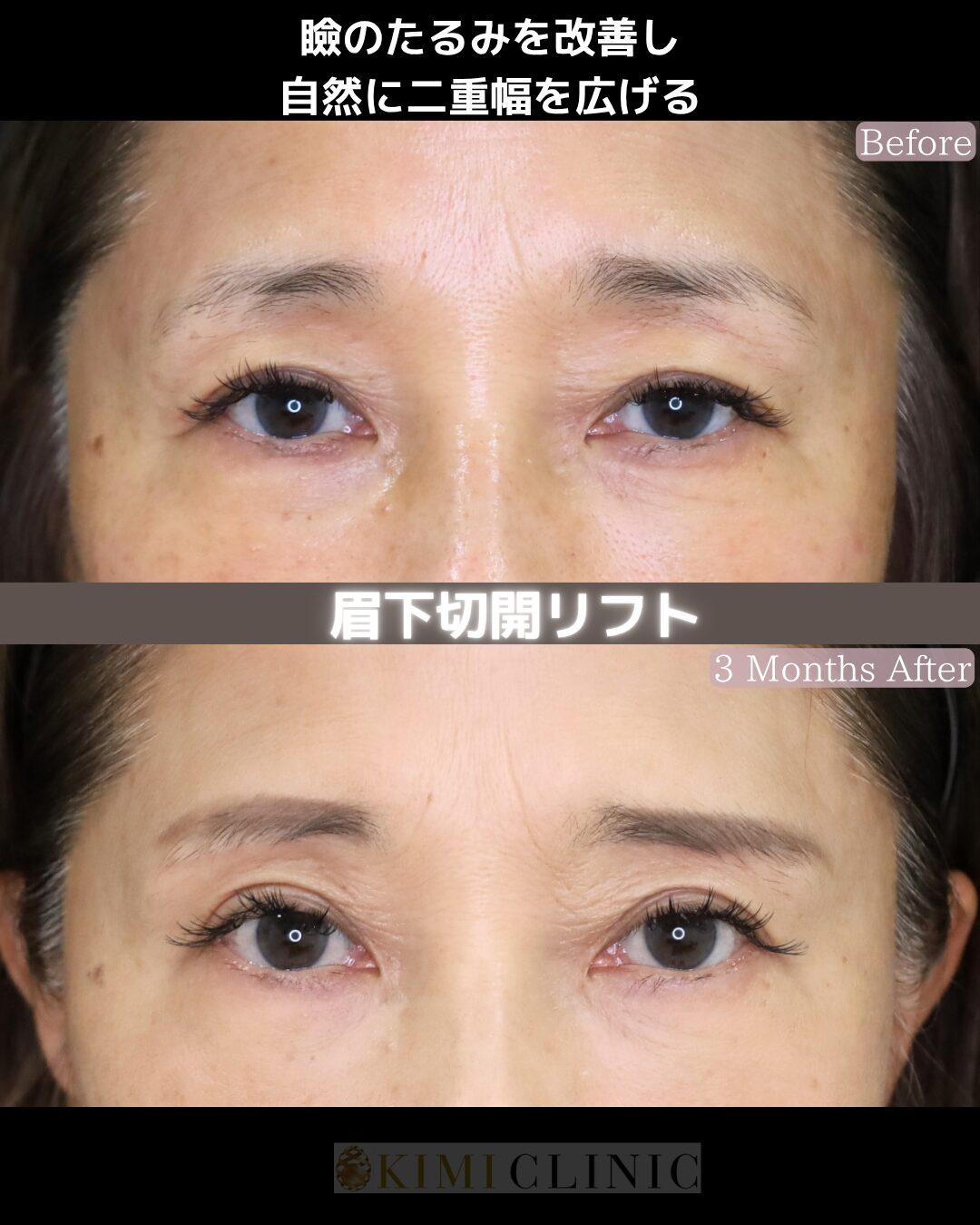 「眉下リフト（切開）」の術前・術後比較Before写真