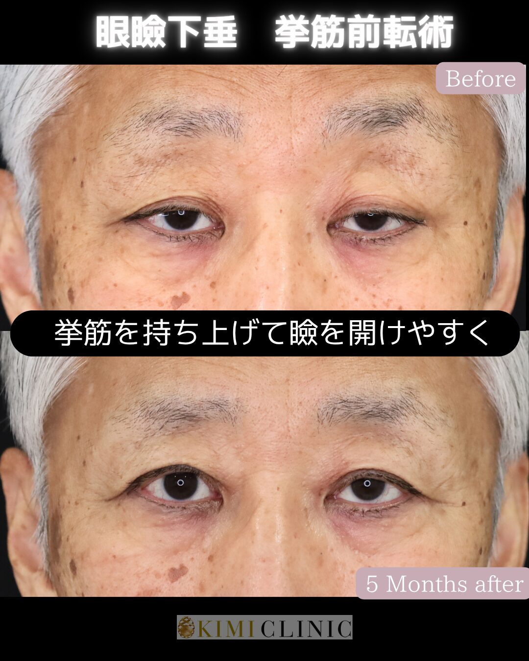 「老人性眼瞼下垂に対する眼瞼下垂手術」の術前・術後比較Before写真