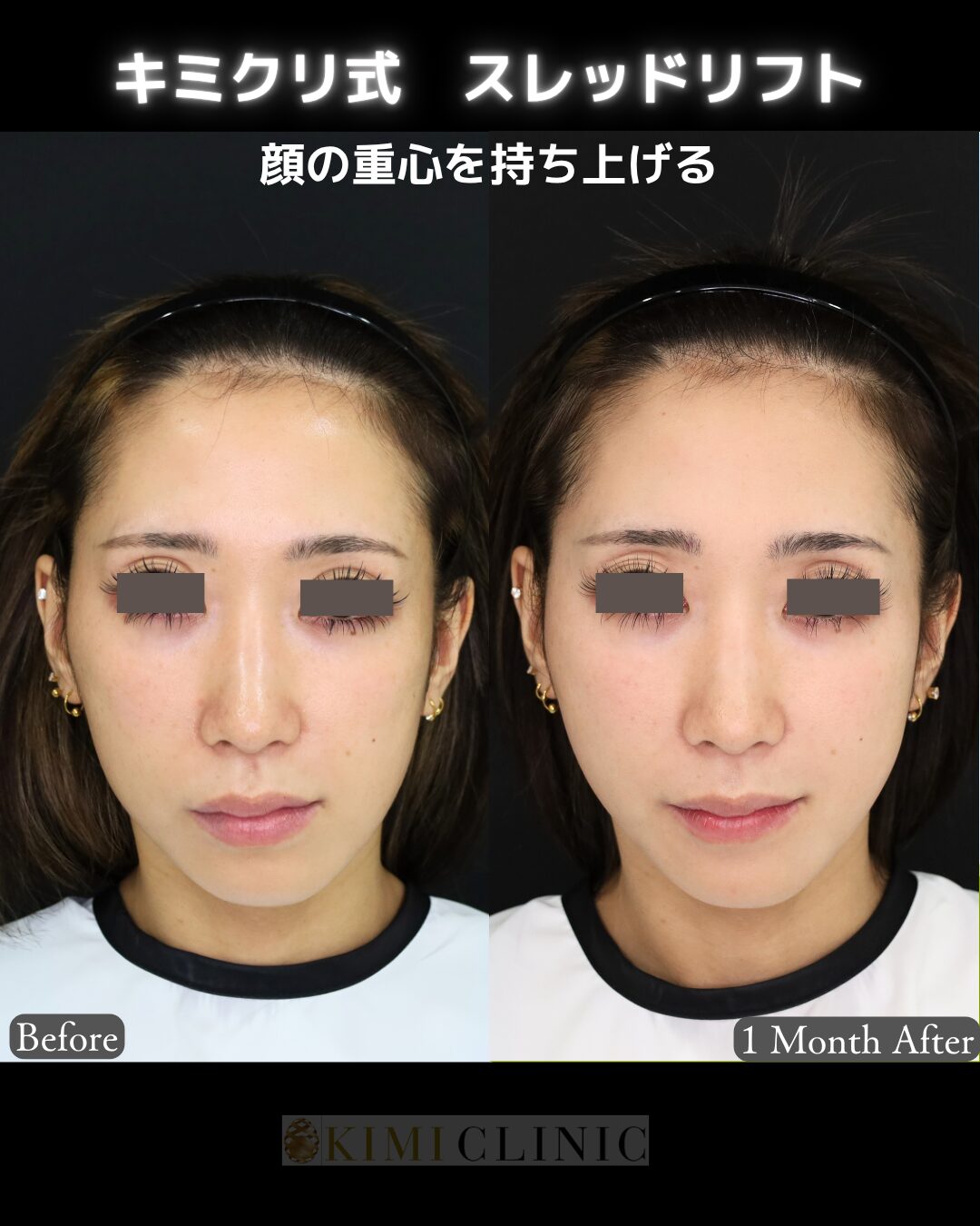 「キミクリ式糸リフト」の術前・術後比較Before写真