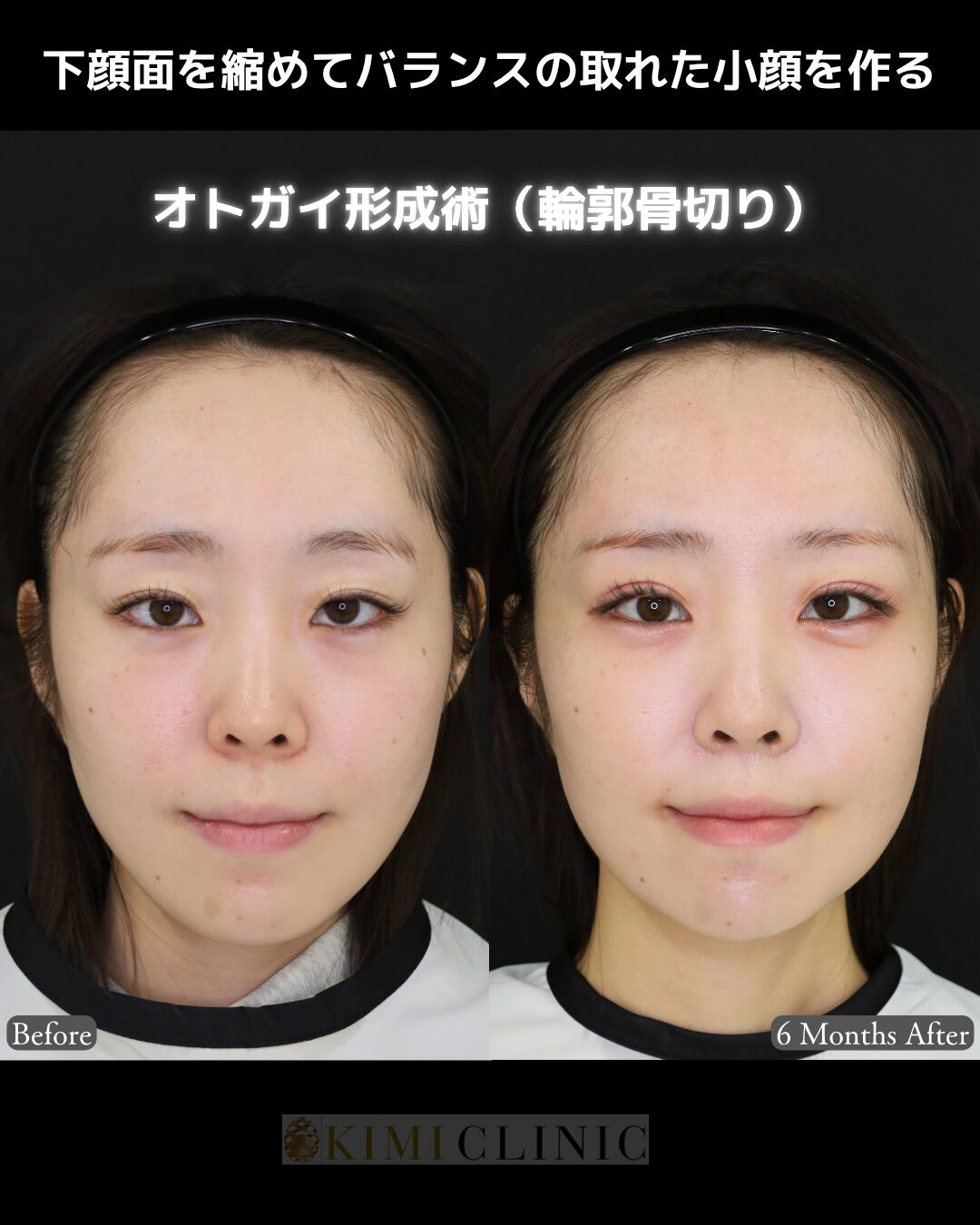 「オトガイ形成術（輪郭骨切り）」の術前・術後比較Before写真