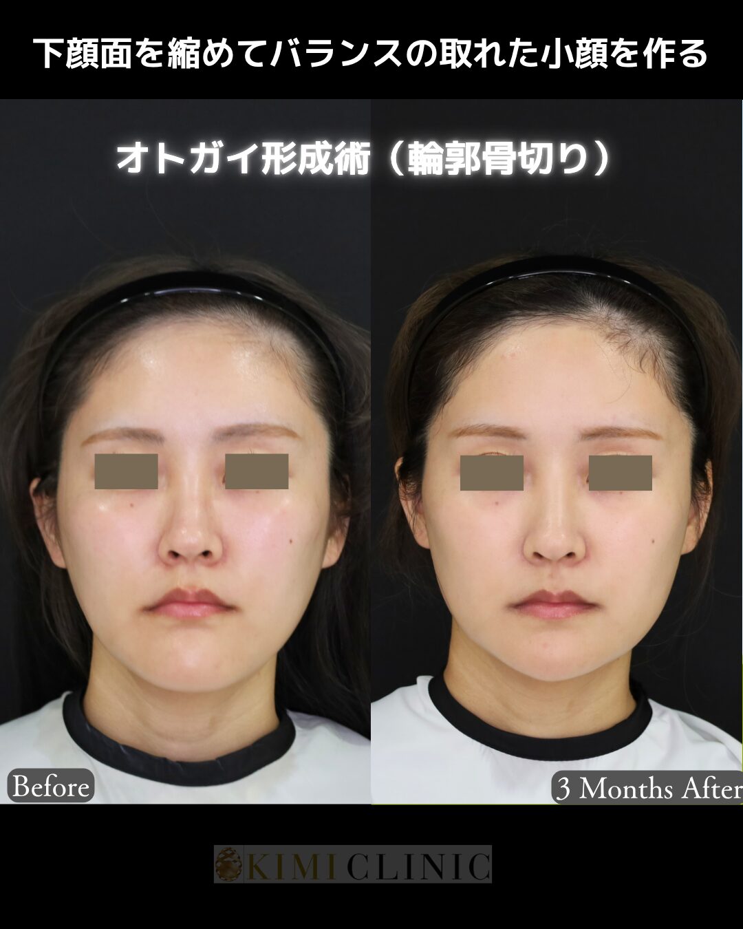 「オトガイ形成術（輪郭骨切り）」の術前・術後比較Before写真