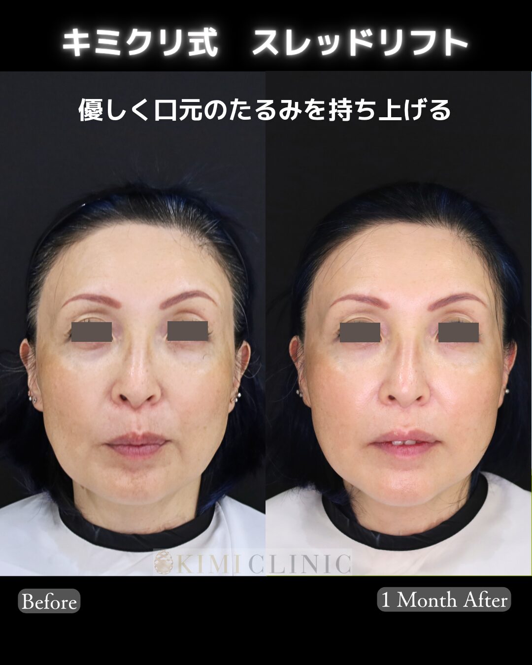「キミクリ式糸リフト」の術前・術後比較Before写真