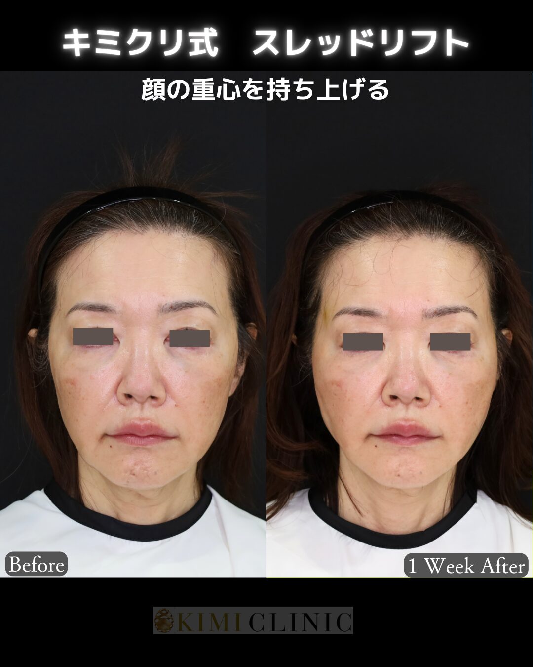 「キミクリ式糸リフト」の術前・術後比較Before写真