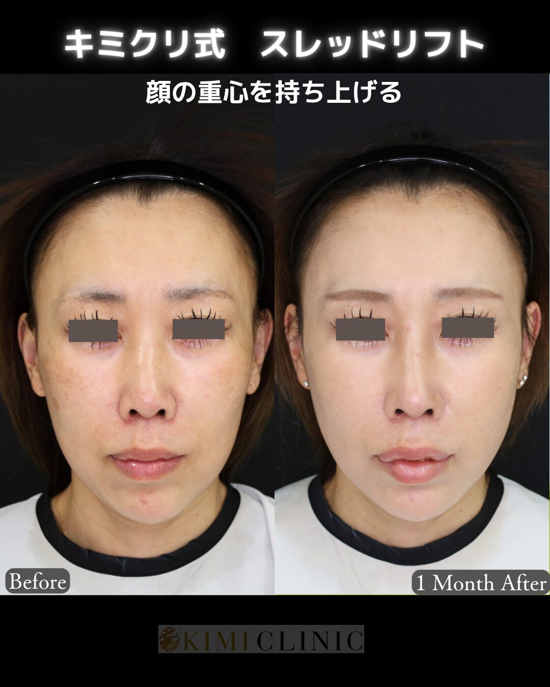 「キミクリ式糸リフト」の術前・術後比較Before写真