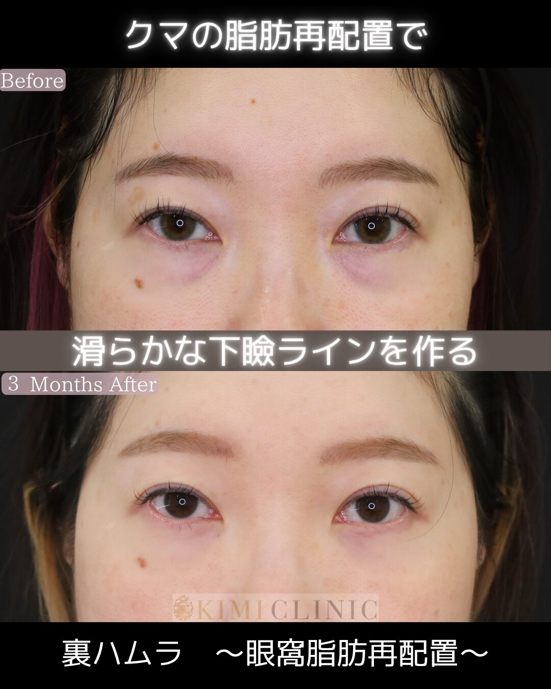 「裏ハムラ法」の術前・術後比較Before写真