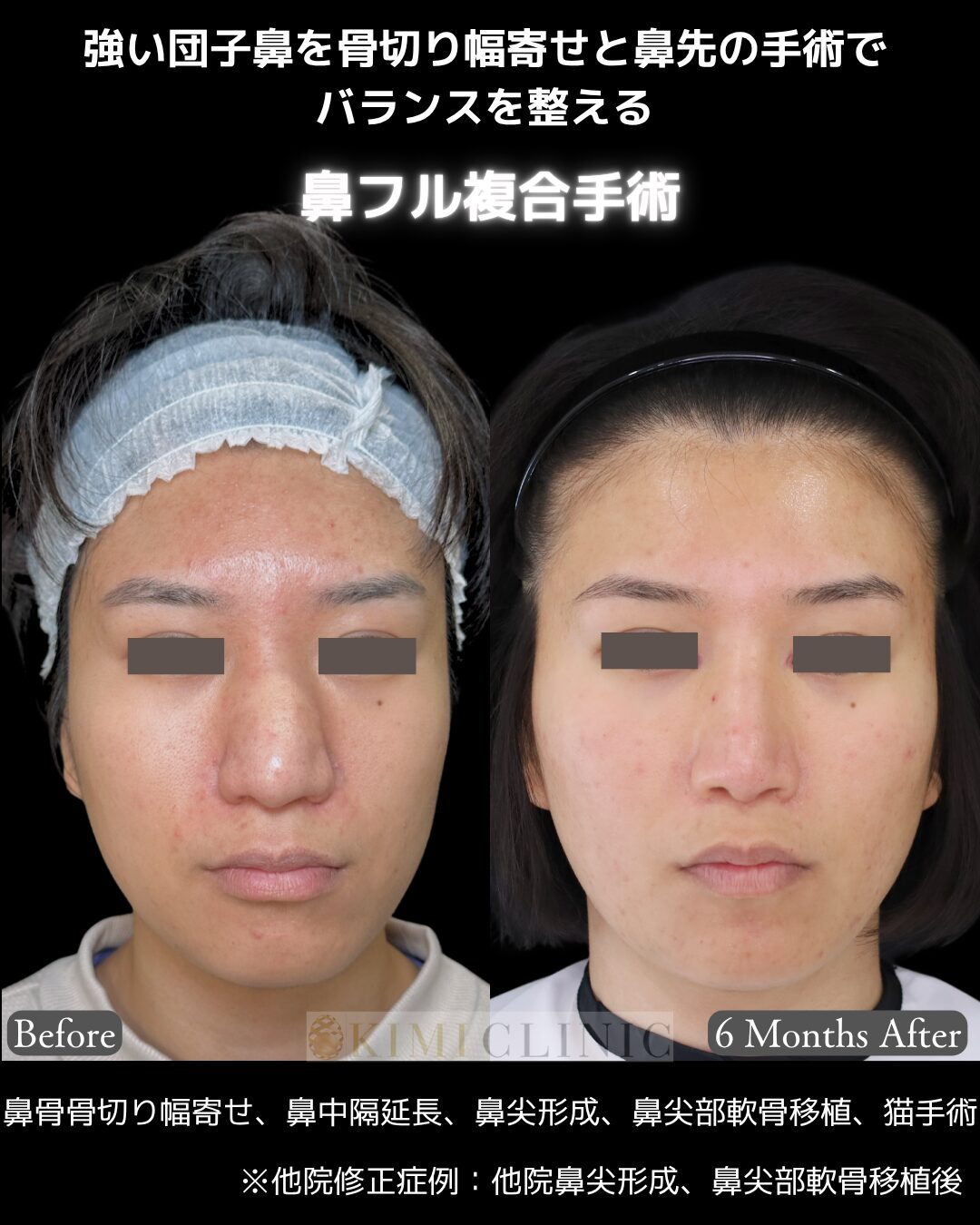 「鼻フル複合手術」の術前・術後比較Before写真