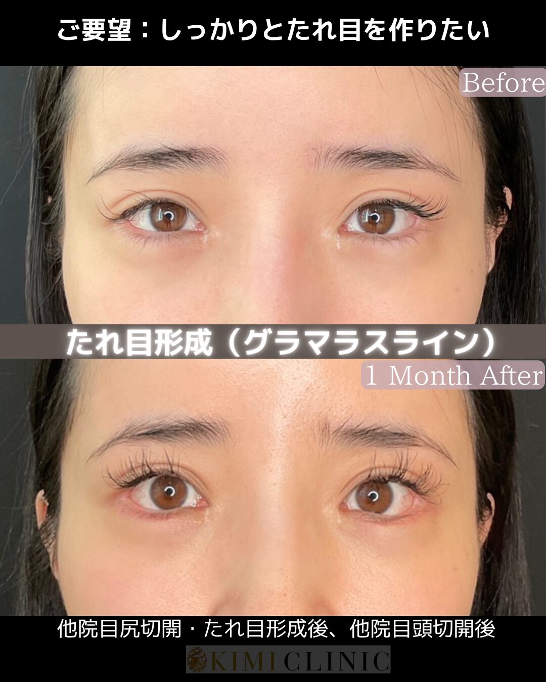 「たれ目形成（グラマラスライン）」の術前・術後比較Before写真