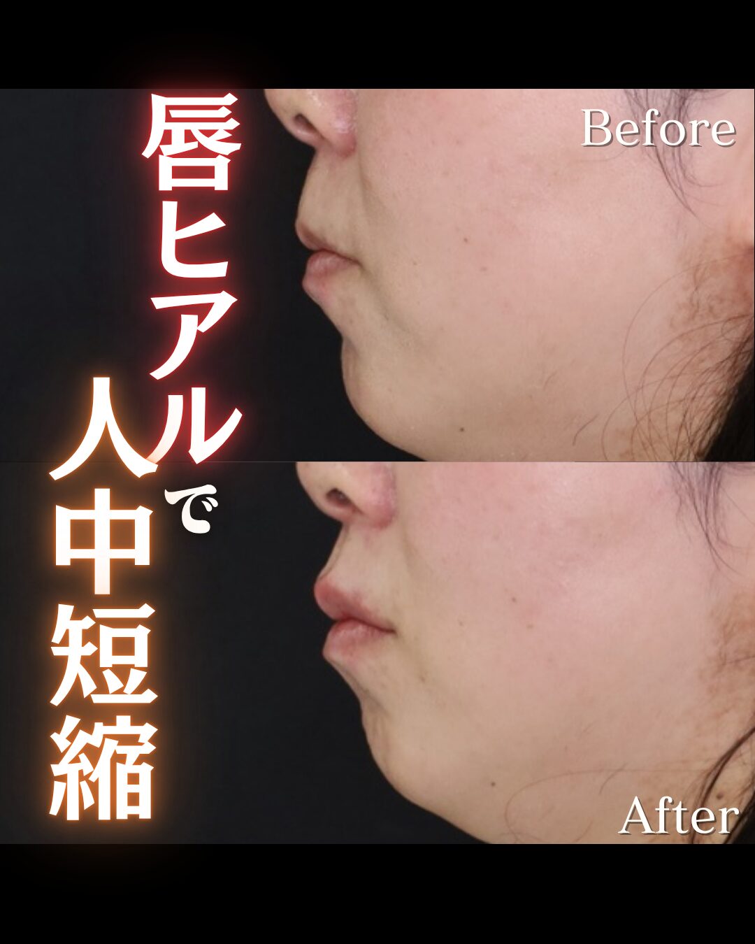 「唇ヒアルロン酸」の術前・術後比較Before写真