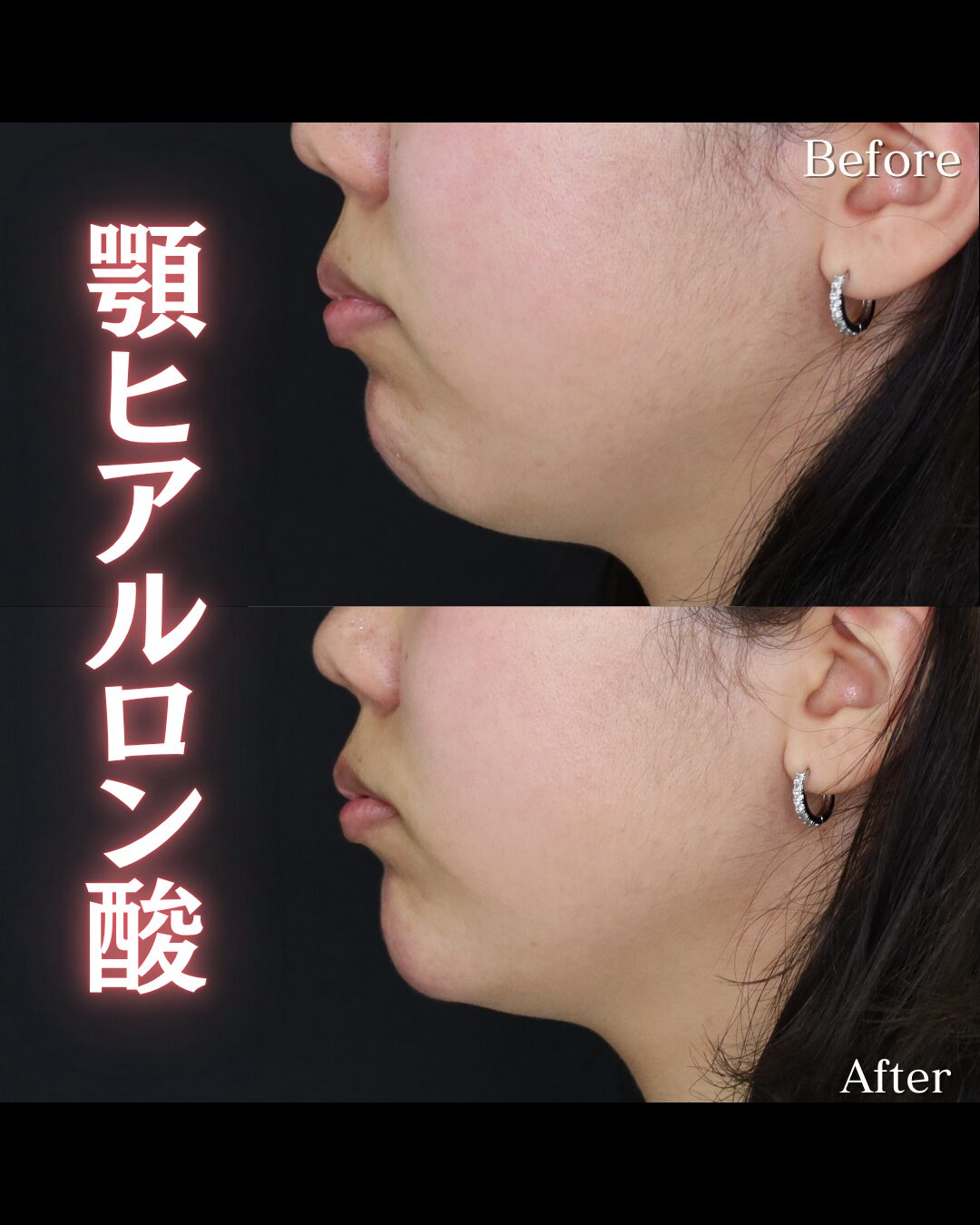 「あごヒアルロン酸」の術前・術後比較Before写真