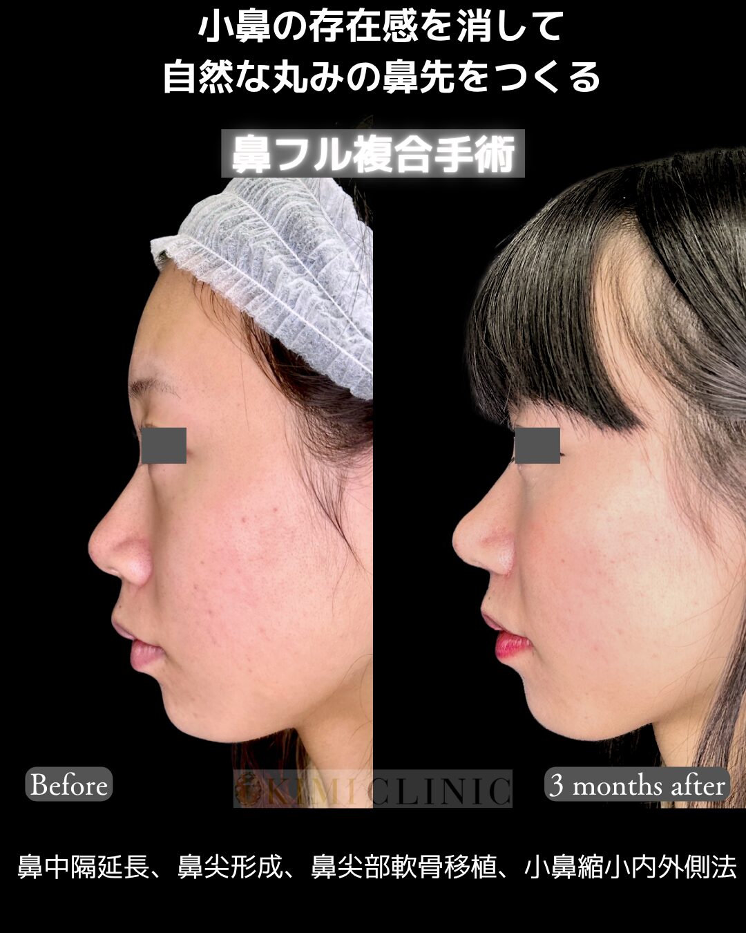 「鼻複合手術」の術前・術後比較Before写真