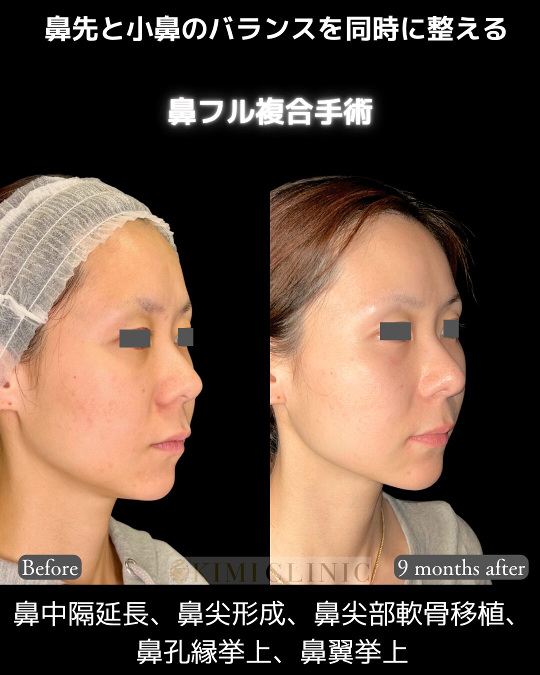 「鼻フル複合手術」の術前・術後比較Before写真