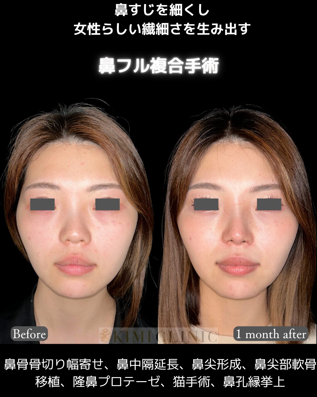 「鼻フル複合手術」の術前・術後比較Before写真