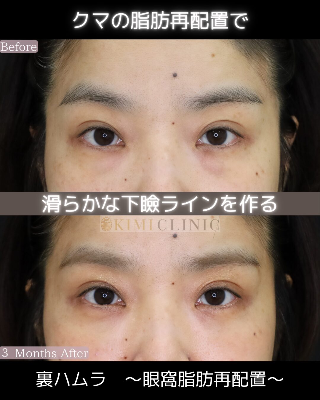 「裏ハムラ法」の術前・術後比較Before写真