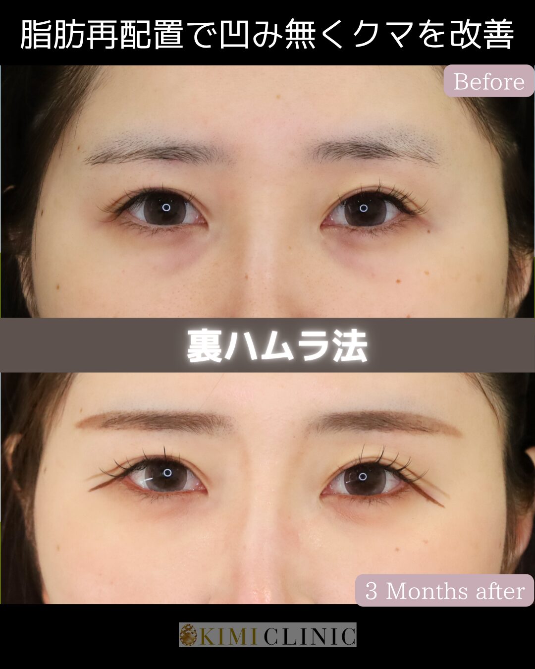 「裏ハムラ法」の術前・術後比較Before写真