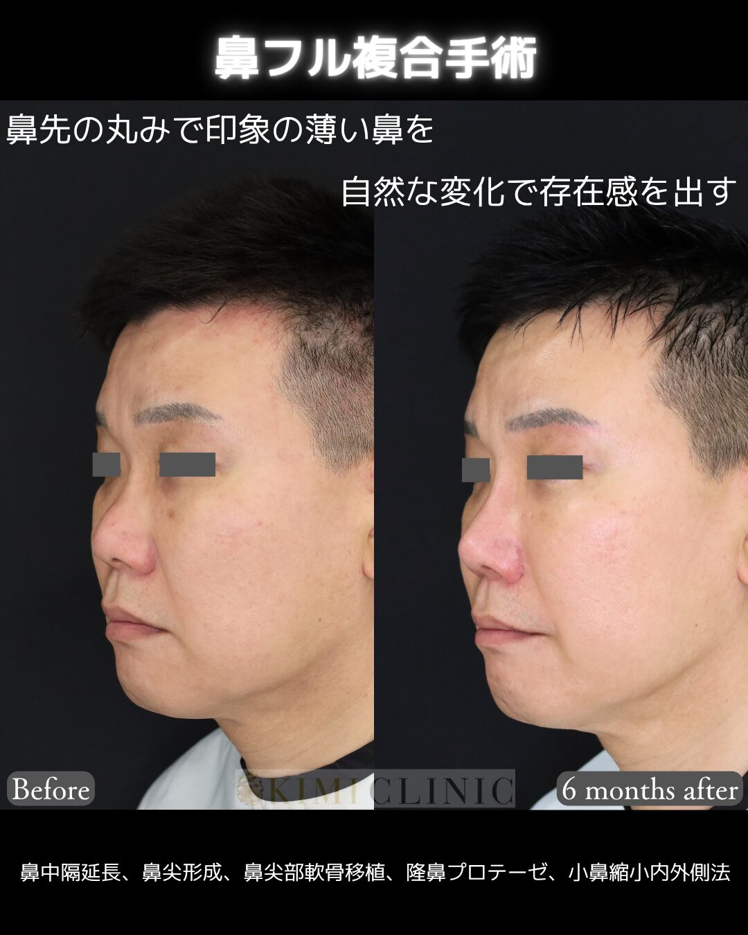 「鼻フル複合手術」の術前・術後比較Before写真