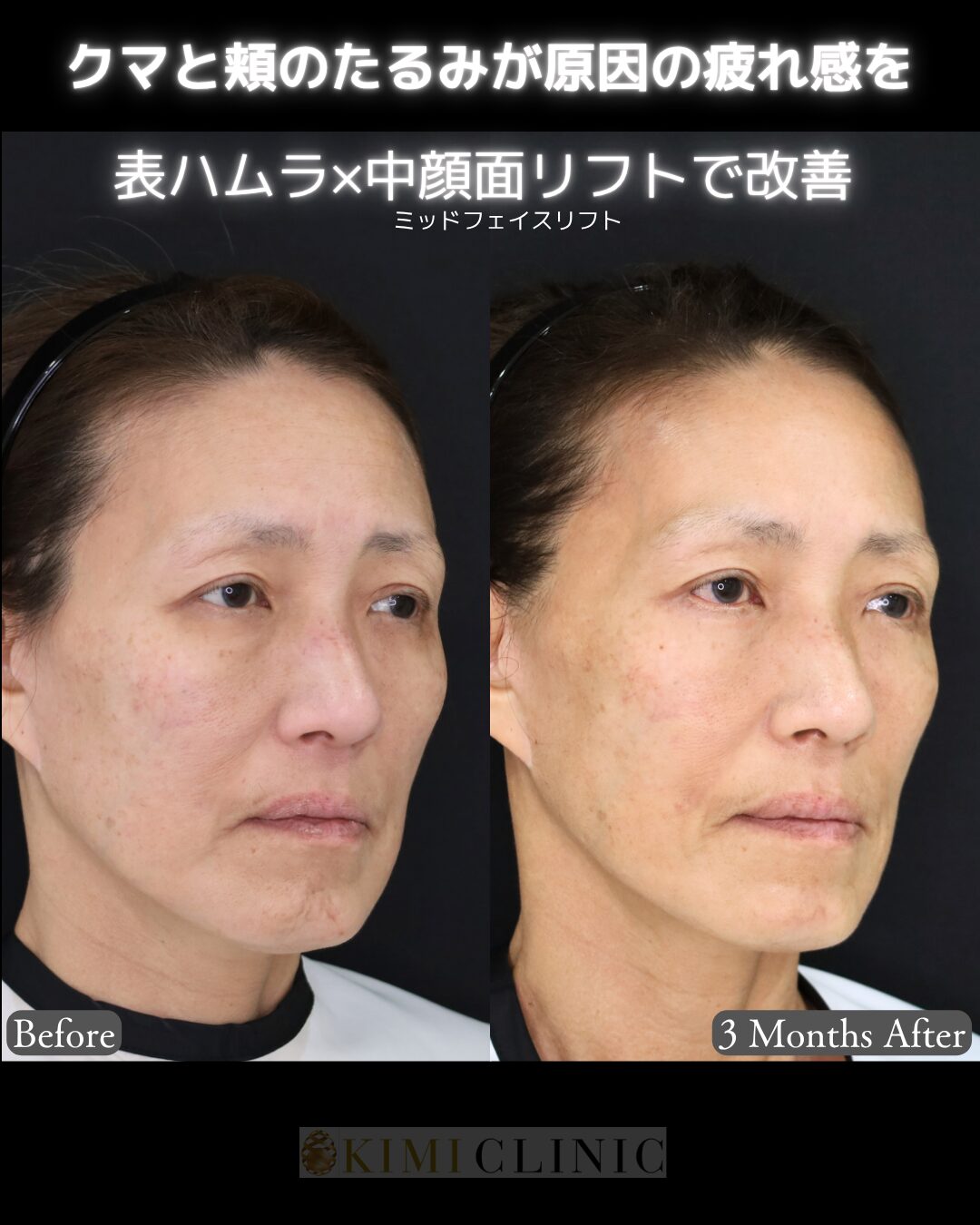「表ハムラ × 中顔面（ミッドフェイス）リフト」の術前・術後比較Before写真