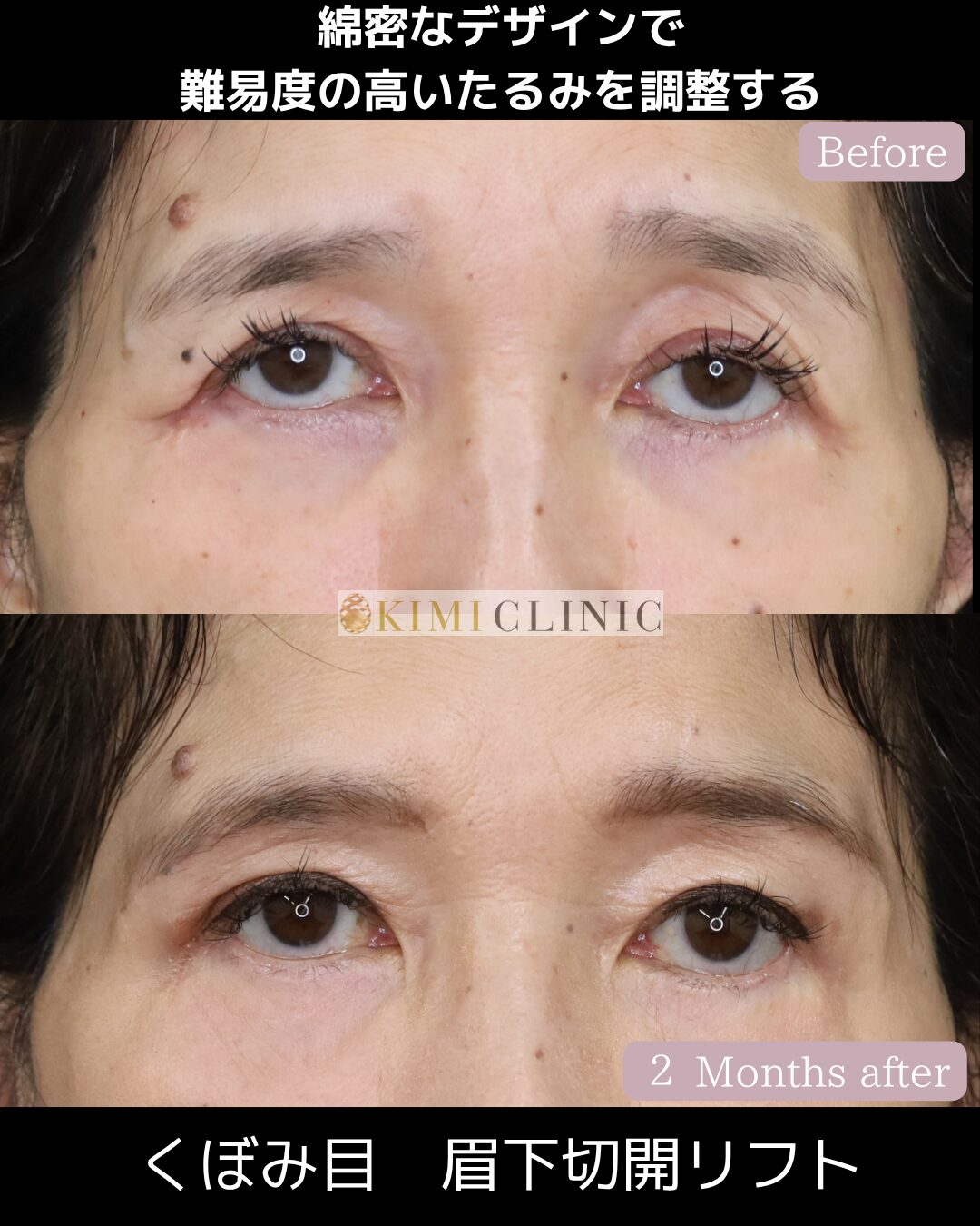 「眉下切開（眉下リフト）」の術前・術後比較Before写真